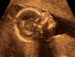Getty Images Curetagem após aborto é a cirurgia mais comum no SUS