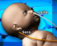 Bebê recebe leite em vez de soro na veia e morre