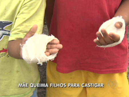 Meninos tiveram as mãos queimadas pela própria mãe
(Rede Record)
Mãos queimadas