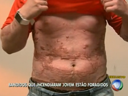 queimado