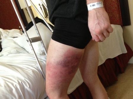 Nate Marquardt mostra perna ap&oacute;s surra no Strikeforce - Mais ...