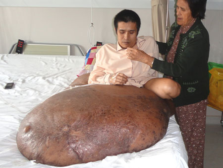 tumor perna 90 kg 450x338