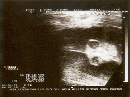 Interrup&ccedil;&atilde;o da gesta&ccedil;&atilde;o de feto com anencefalia n&atilde;o &eacute; aborto ...