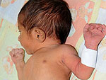 Bebê passa por<br>cirurgia no Paquistão