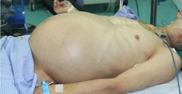 Chinês internado com 'barriga de grávida' descobre tumor no rim