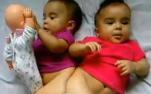 Siamesas passam por cirurgia de separação